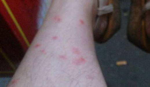 人被跳蚤咬过的图片：跳蚤咬人后图片和症状（不容忽视）