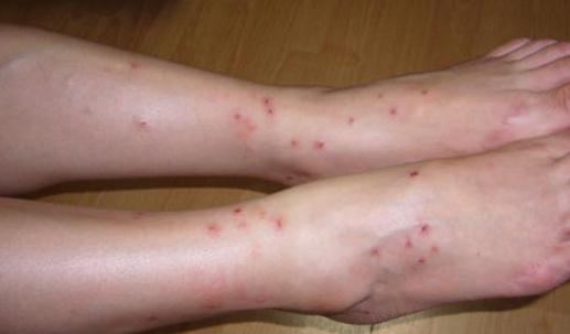 人被跳蚤咬过的图片：跳蚤咬人后图片和症状（不容忽视）