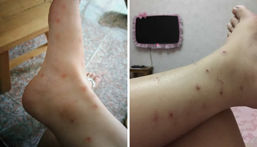 人被跳蚤咬过的图片：跳蚤咬人后图片和症状（不容忽视）