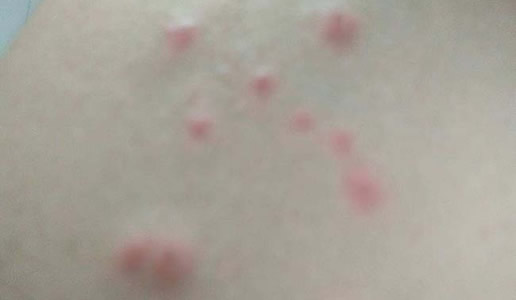 人被跳蚤咬过的图片：跳蚤咬人后图片和症状（不容忽视）