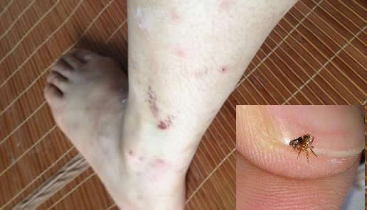 被跳蚤咬的症状图片：不小心被跳蚤咬了危害有哪些