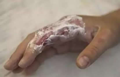 烫伤后怎么处理，用牙膏冰块等方式不靠谱