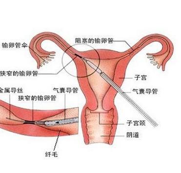 子宫后位是什么意思：子宫前位好还是后位好
