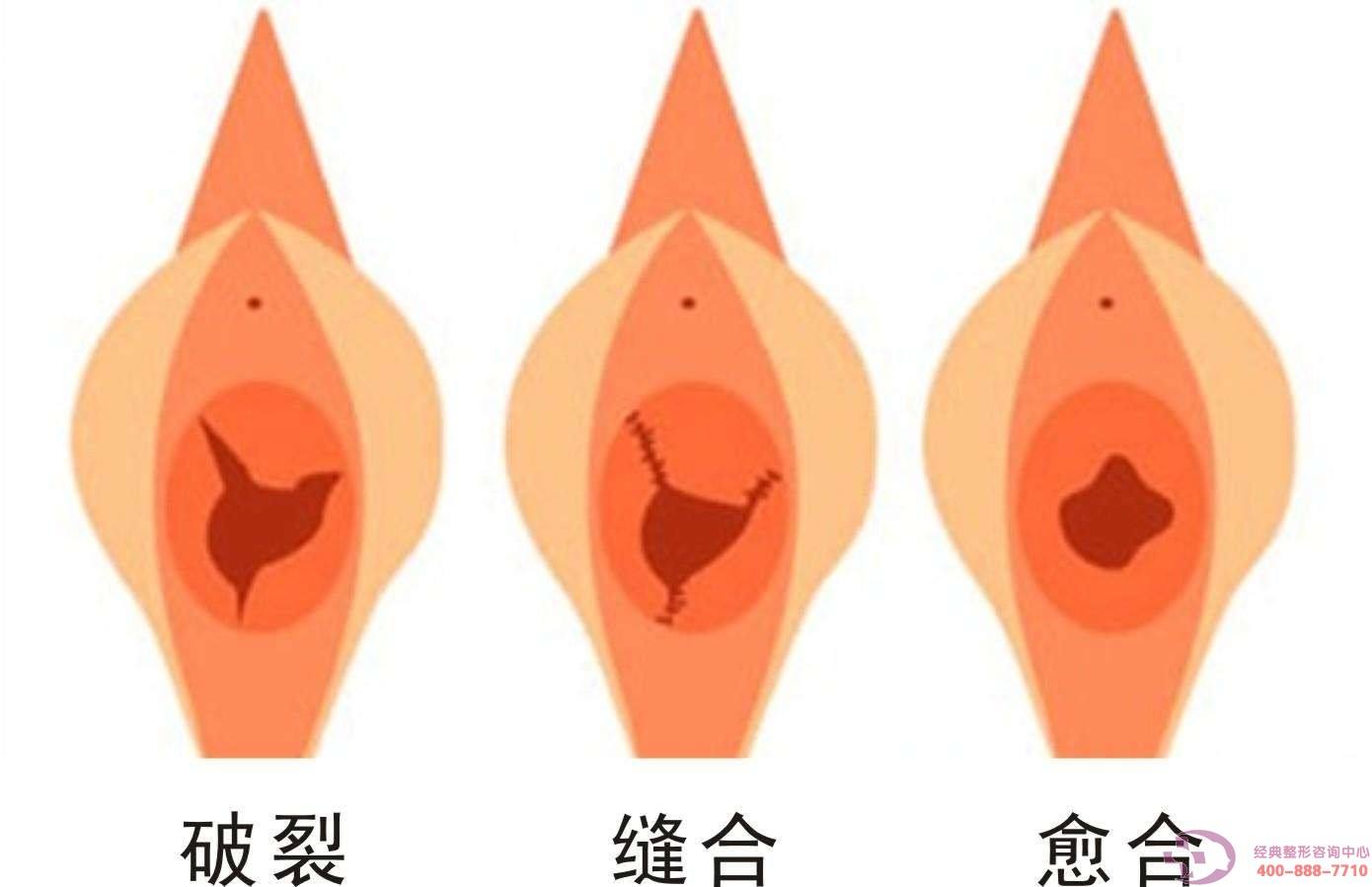 处女膜修复
