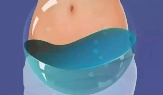 盆腔积液20mm严重吗