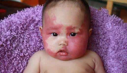 孕妇不能吃哪些食物 孕妇怎么防止孩子胎记