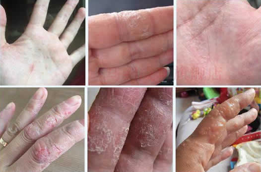 汗疱疹图片和症状图片：汗疱疹怎么引起的能自愈吗