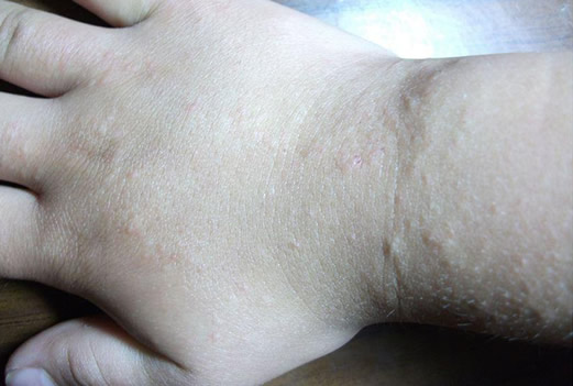 汗疱疹图片和症状图片：汗疱疹怎么引起的能自愈吗