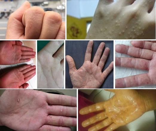 汗疱疹图片和症状图片：汗疱疹怎么引起的能自愈吗