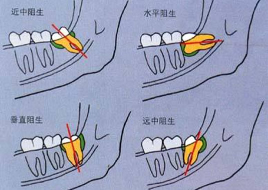 等拔智齿太久自杀：背后始末详情是怎么回事？