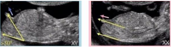 检查nt的时候可看出来男女吗,看哪个数据能看出来男女?