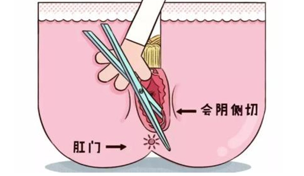 顺产侧切手术全过程以及术后护理的正确方法（附图）