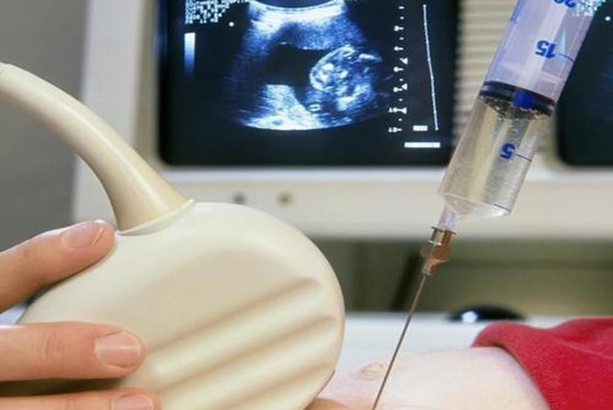 羊水穿刺是什么意思 什么是羊水穿刺