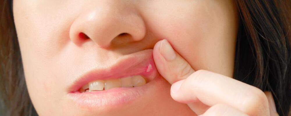 冬季高发口腔溃疡 这些人是高发人群