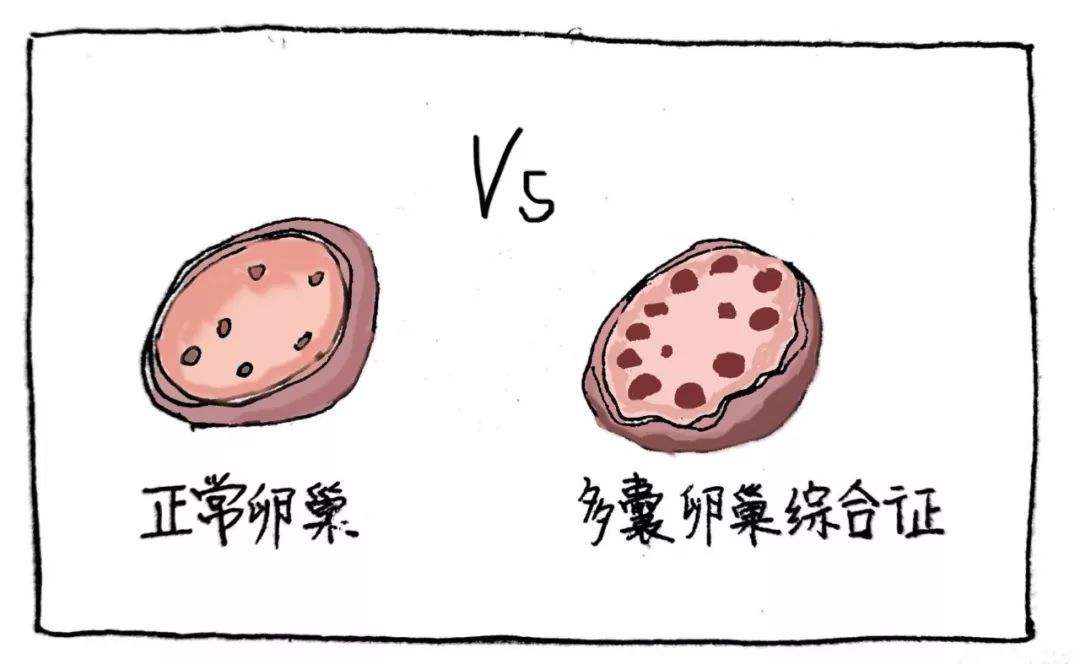 多囊卵巢综合征是什么原因引起的