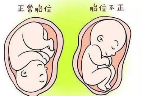 产妇选择分娩方式,什么情况下不考虑顺产