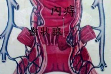 产后痔疮的来源 如何缓解产后痔疮疼?