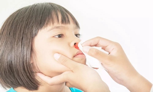 流鼻血是什么原因？小孩子流鼻血怎么快速止血