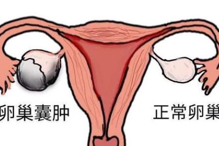 卵巢囊肿吃什么药消除