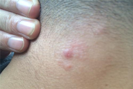 脖子上长小肉疙瘩或是这四种原因