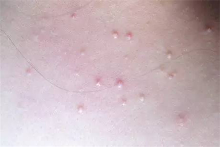 脖子上长小肉疙瘩或是这四种原因