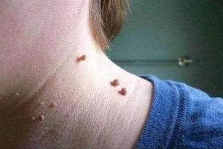 脖子上长小肉疙瘩或是这四种原因