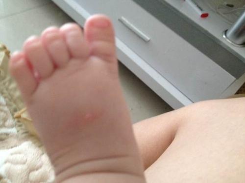 蚊虫叮咬如何快速止痒