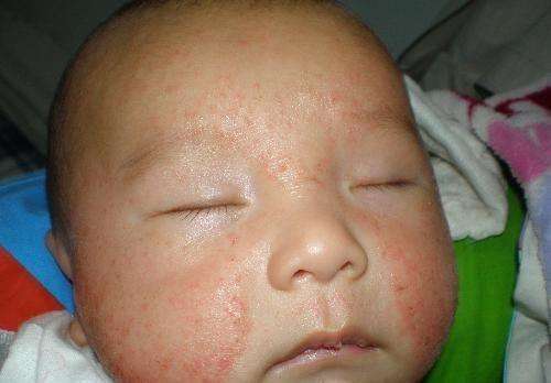 冬季宝宝湿疹又犯了,防治婴儿湿疹,这5招最靠谱!