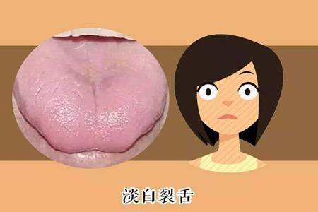 舌苔厚白是怎么回事 为什么婴儿会出现舌苔厚白情况