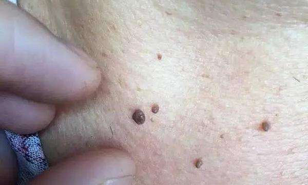 别找了！脖子上长小肉疙瘩的原因,无非就是这6个！