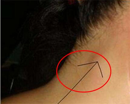 脖子上长小肉疙瘩：皮肤增生物或青春痘的一种（图）