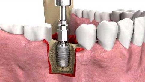 杭州种植牙技术——史上最详细的种植牙,了解一下?
