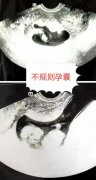 流产7次 在市妇幼保健院辅助生殖分院成功保胎平安产女