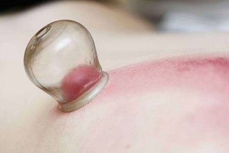 拔火罐有什么好处 拔火罐的教学方法