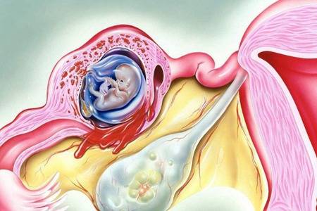 宫外孕怎么办是如何引起的 女性早期宫外孕的治疗方法