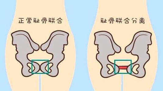 孕期有一种难熬的痛叫耻骨痛，没经历过的人根本不会懂