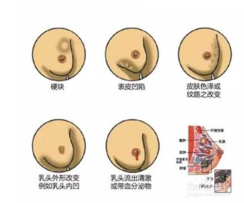 乳腺癌早期症状解读