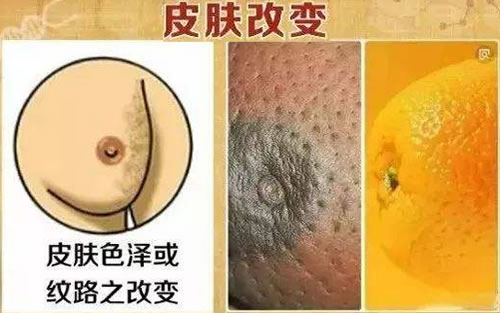 乳腺癌早期症状解读