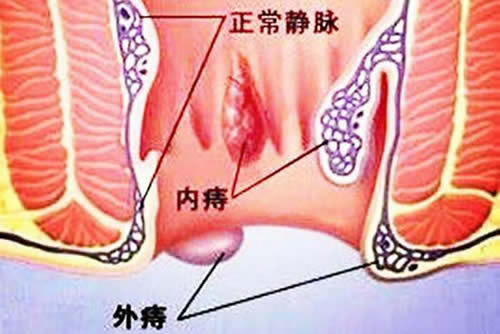 真实女性痔疮图片:女性痔疮的症状及危害 真实女性痔疮图片:女性痔疮的症状及危害