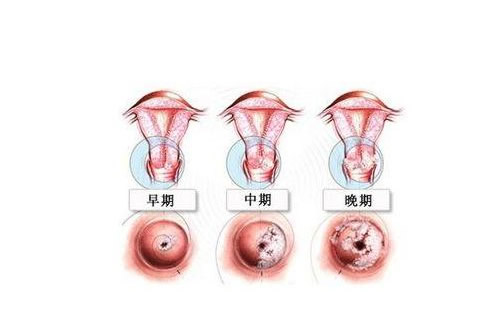 真实女性痔疮图片:女性痔疮的症状及危害 真实女性痔疮图片:女性痔疮的症状及危害