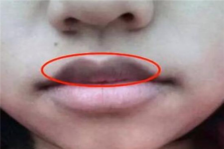 嘴唇发黑或是这五种原因