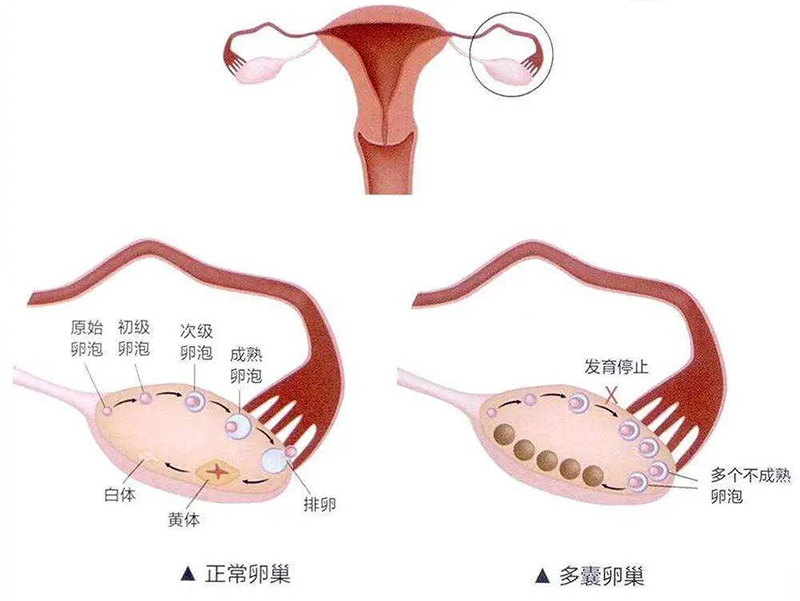 患有多囊还可不可以生宝宝,注意什么？