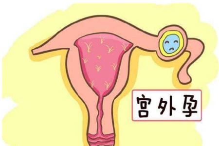 两个原因导致宫外孕越来越多
