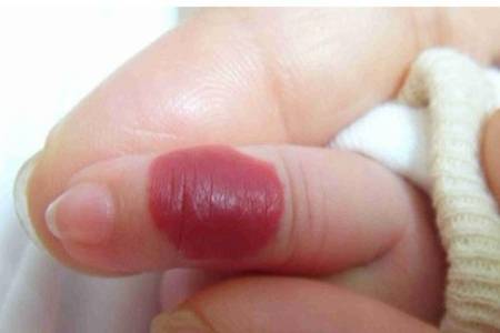 血管瘤是怎么形成的？怎么预防血管瘤复发