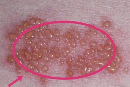 带状疱疹会传染吗？这三个预防带状疱疹的症状表现