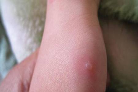 水痘的症状有哪些？治疗水痘要及时莫惊慌