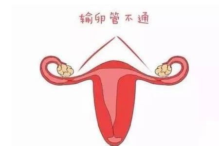 输卵管造影会痛的两个常见原因