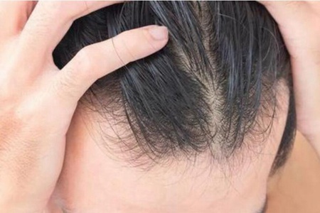 肾虚型脱发怎么改善？肾虚型脱发的原因