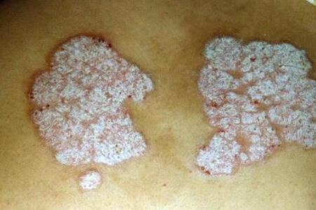 牛皮癣传染吗？这四个牛皮癣复发的症状