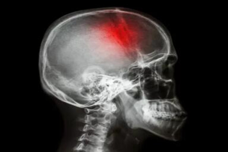 脑出血是怎么引起的？这四个诱发脑出血症状及表现